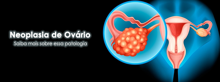 Neoplasia de Ovário