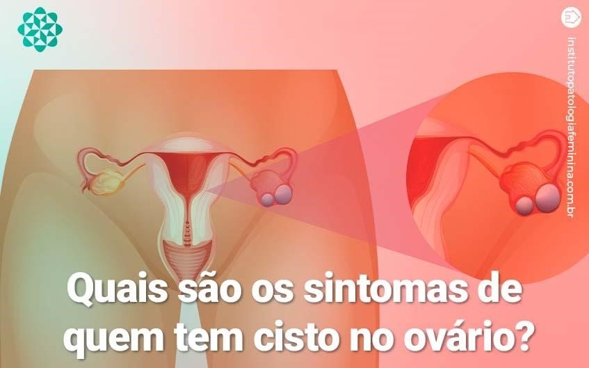 Quais são os sintomas de quem tem cisto no ovário?